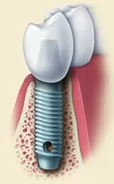 tooth implants with a Utah County dentist in Provo”, “titanium dental implants in Provo and Orem