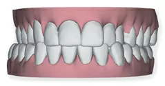 clear braces with a Provo dentist Utah County