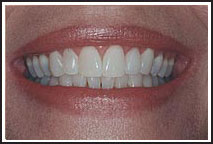 Teeth whitening with a Provo dentist Orem Utah