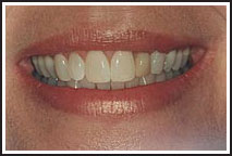 tooth whitening in Provo and Orem