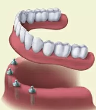 dentures vs dental bridge Provo dentist in Utah County