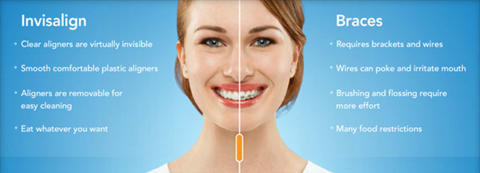 Invisalign braces vs metal braces for teeth straightening with a Utah County dentist Provo and Orem