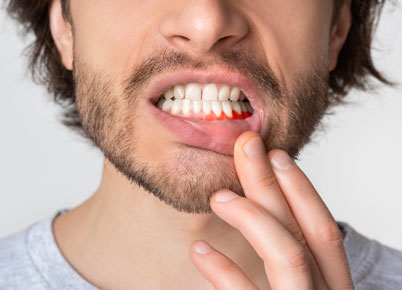 Man showing swollen gums from gum disease