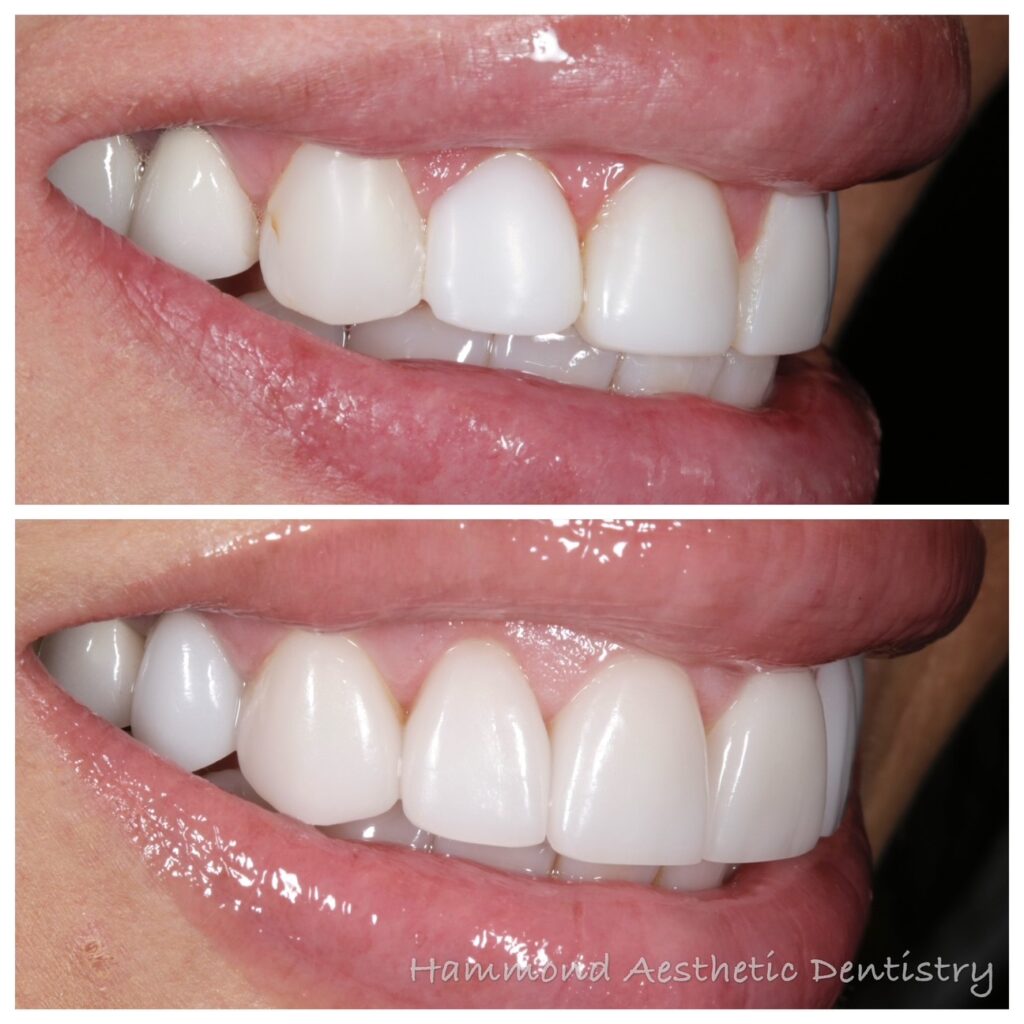 Utah County woman shows her dream smile tranformation from Provo dentist