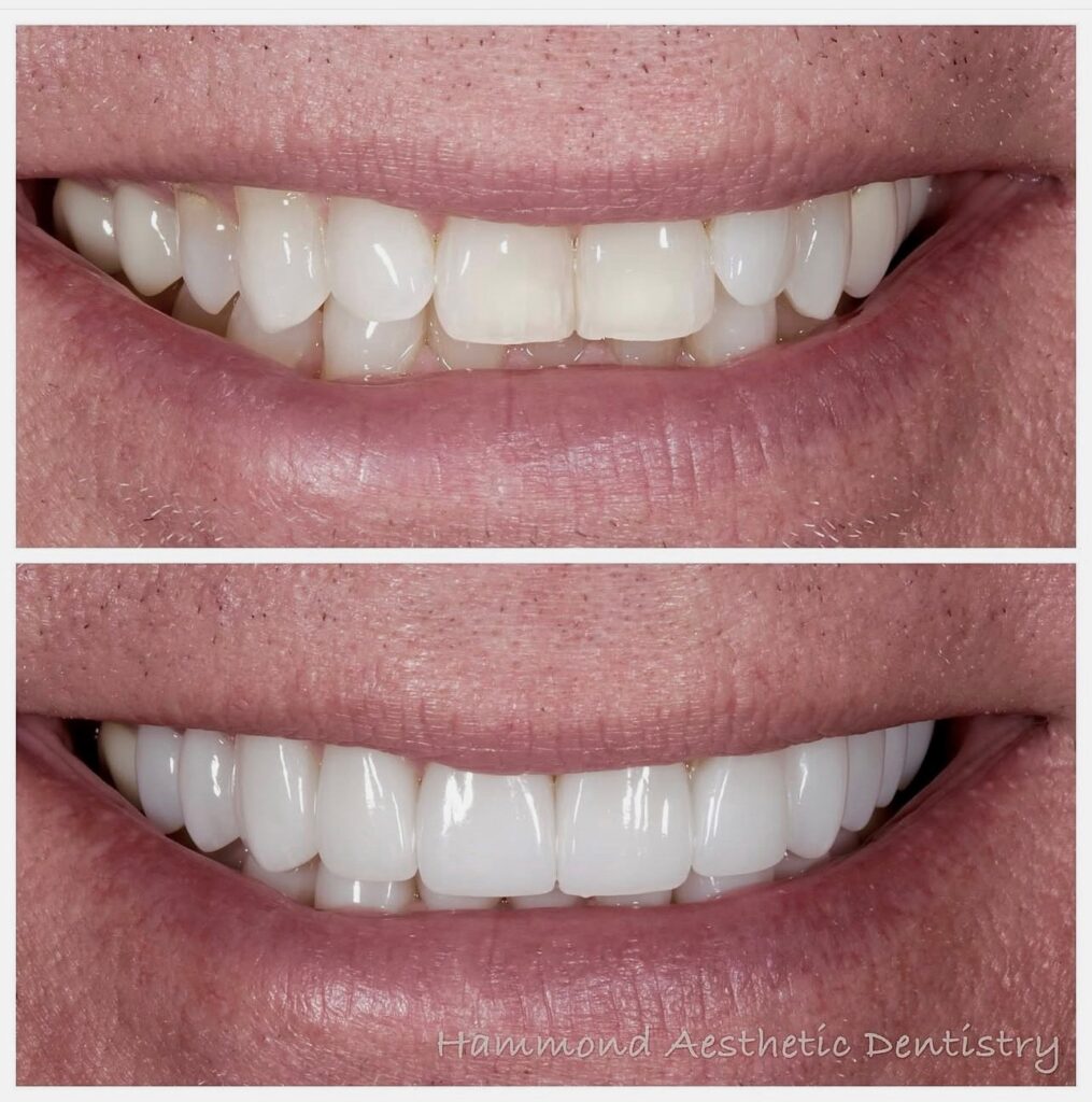 Utah County patient shows off his before and after dental treatment at Provo dentist
