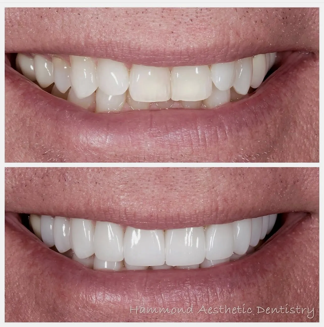 Utah County patient shows off his before and after dental treatment at Provo dentist