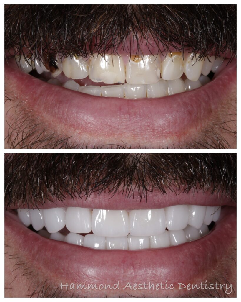 Orem man shows off dental restoration after treatment at Utah County dentist