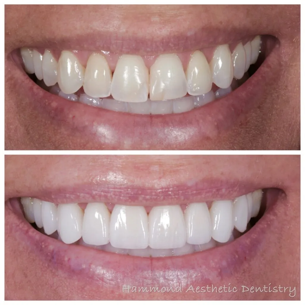 before and after porcelain veneers from Provo cosmetic dentist