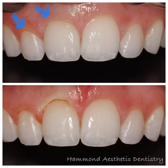 before and afters of laser dentistry treatment in Provo