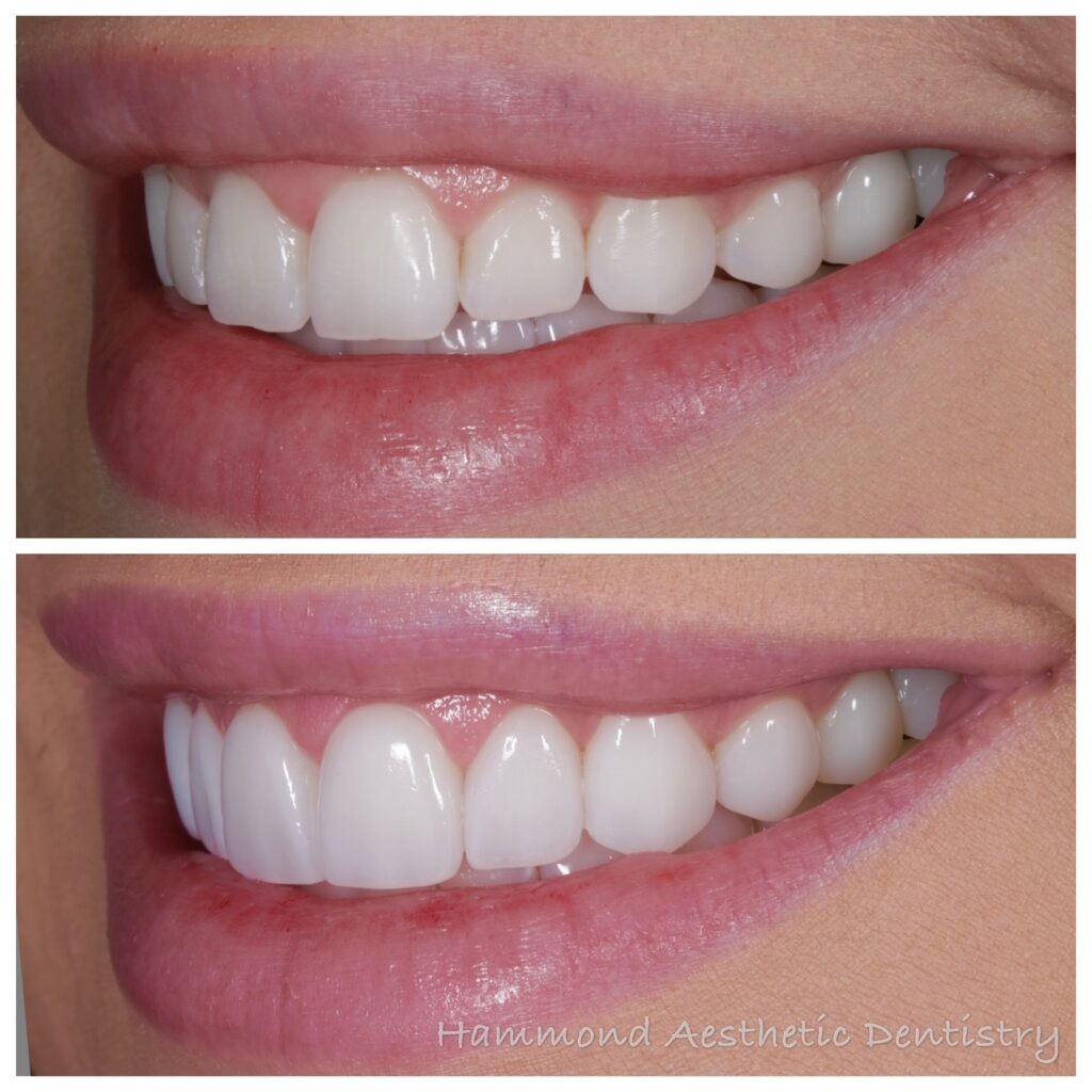Utah County patient's before and after laser dental treatment in Provo