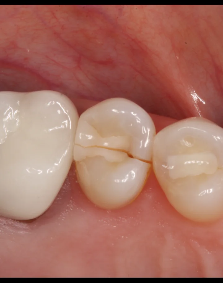 cracked tooth repaired by Provo emergency dentist