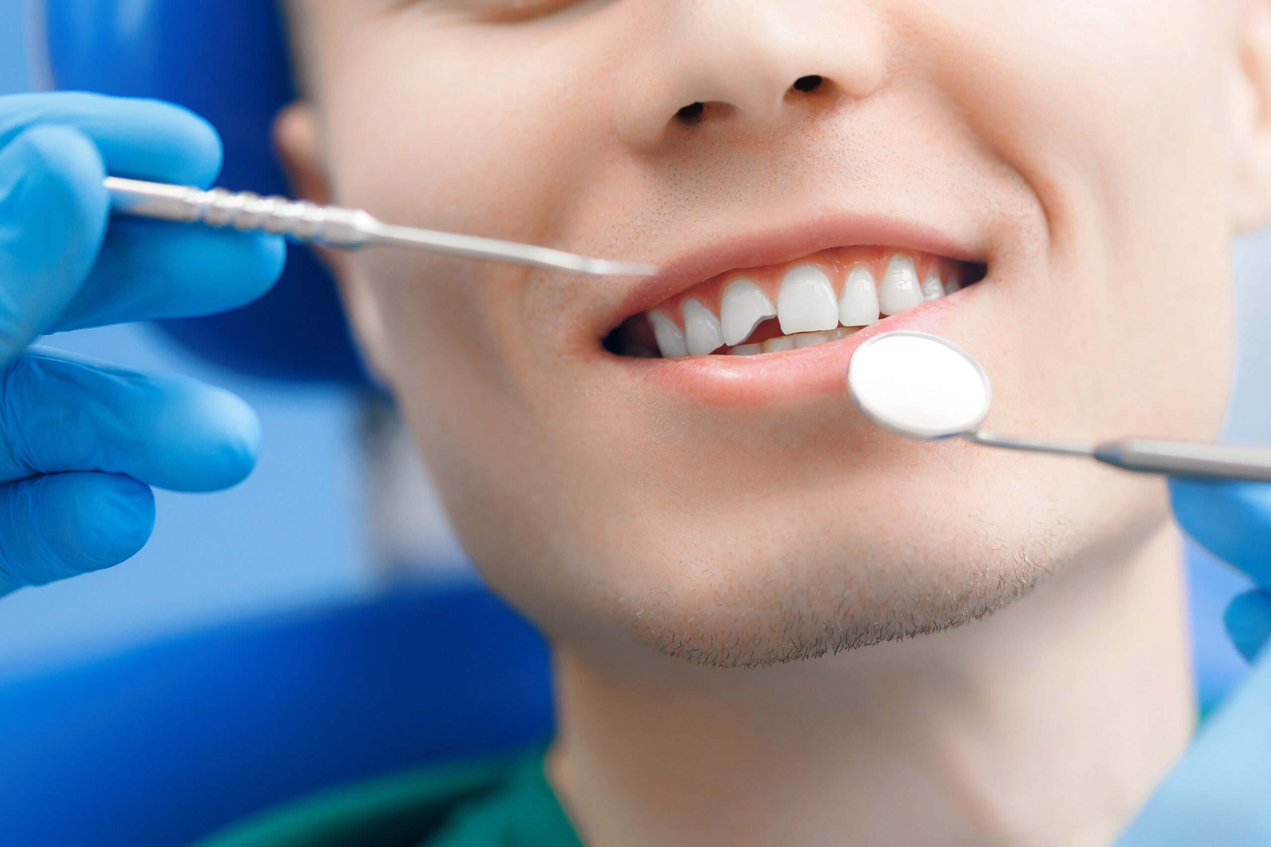 Key Differences Between Bonding and Veneers for Chipped Teeth