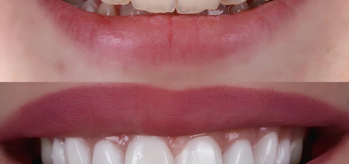 instant orthodontics: before and after treatment